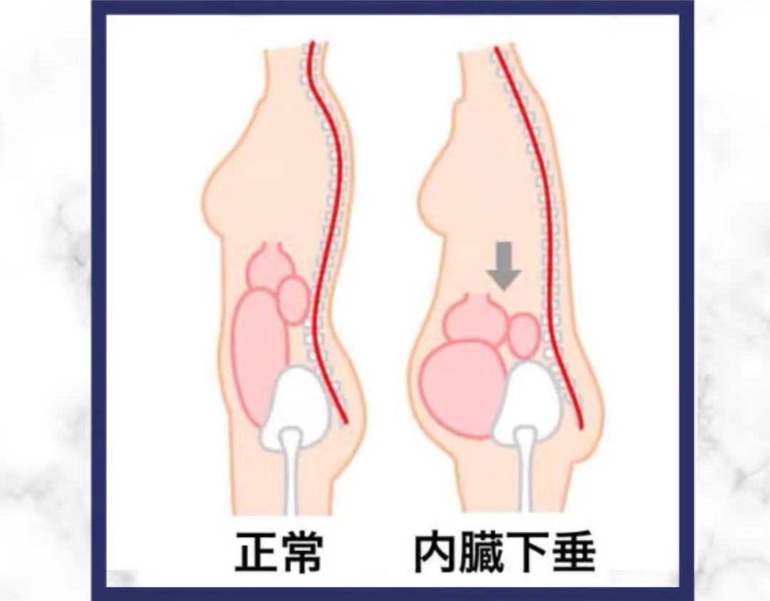 内臓下垂